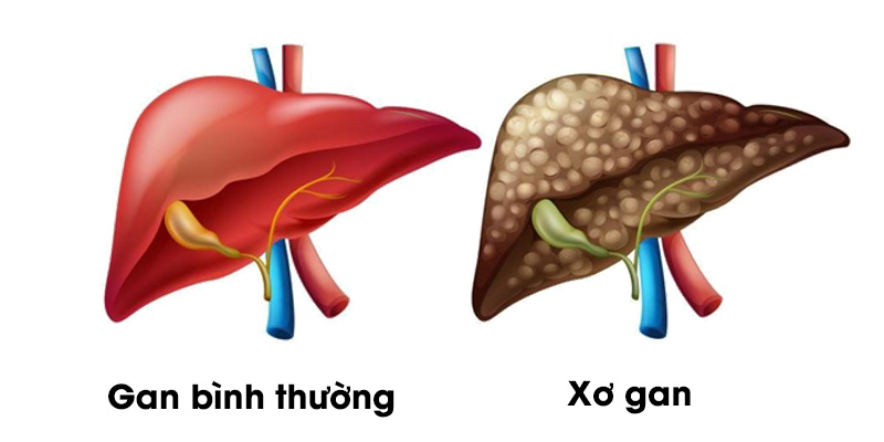 So sánh gan bình thường và xơ gan