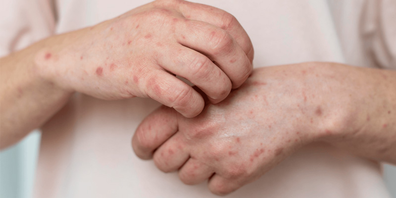 Dị ứng da không rõ nguyên nhân có thể là dấu hiệu của xơ gan giai đoạn 2