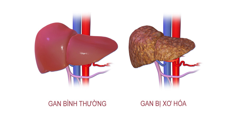 Xơ gan giai đoạn cuối
