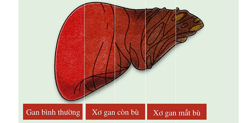 Xơ gan mất bù là bệnh lý vô cùng nghiêm trọng có thể đe dọa tính mạng người bệnh