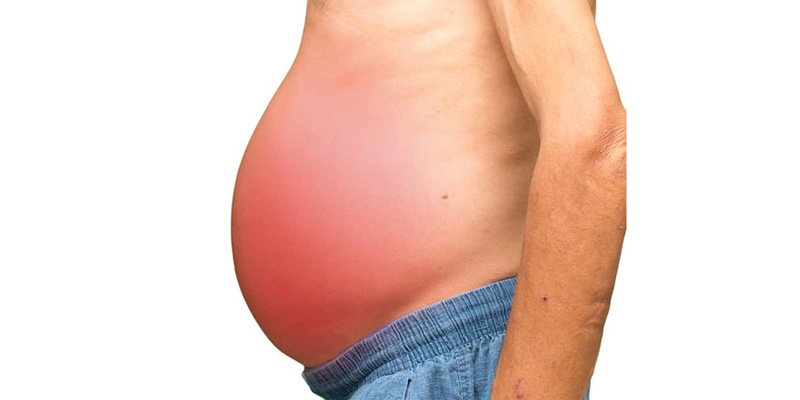 Bệnh xơ gan có thể gây phù nề, chướng bụng