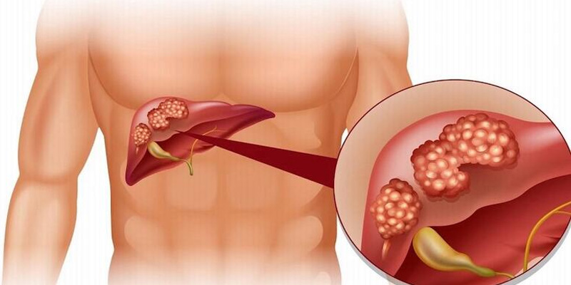 Xơ gan mất bù nguy hiểm như thế nào?
