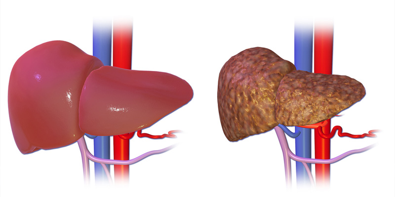 Gan trong giai đoạn 4 rất nguy hiểm và bị tổn thương nặng nề bởi các mô sẹo