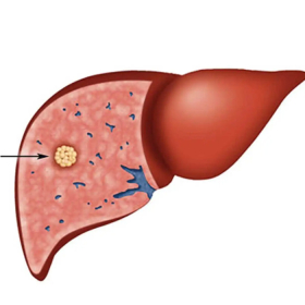Ung thư gan có chữa được không? Sự thật bạn nên biết