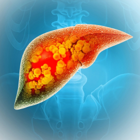 Bệnh chai gan có nguy hiểm không? Dấu hiệu, biến chứng cần biết