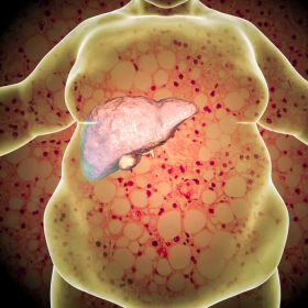 Người bị gan nhiễm mỡ độ 3 có chữa được không?