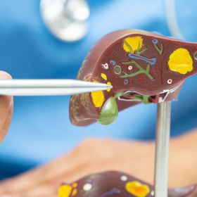 Bệnh xơ gan giai đoạn 3 sống được bao lâu?