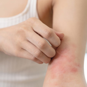 Nhận biết biểu hiện ngoài da của bệnh gan không nên bỏ qua