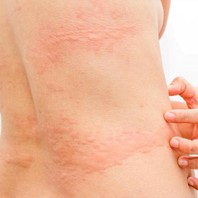 Nhận biết dấu hiệu u gan ác tính thường gặp giúp phát hiện bệnh kịp thời