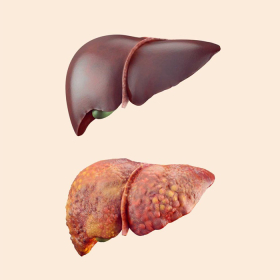 Gan nhiễm mỡ: Nguyên nhân, triệu chứng, chẩn đoán và điều trị
