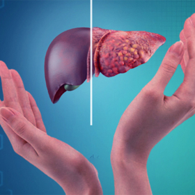 Gan nhiễm mỡ có nguy hiểm không? 5 biến chứng cần biết