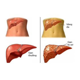 Gan nhiễm mỡ có sao không? Những dấu hiệu cảnh báo