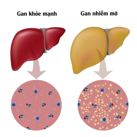 Gan nhiễm mỡ độ 1 là gì? Nguyên nhân, triệu chứng và điều trị