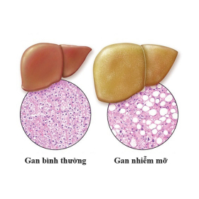 Gan nhiễm mỡ độ 2 có nguy hiểm không? Phương pháp điều trị cần biết