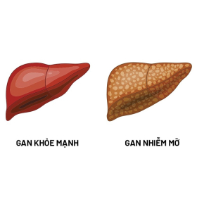 Gan nhiễm mỡ độ 3: Triệu chứng, điều trị và phòng ngừa