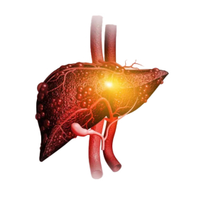 Gan nhiễm mỡ độ 4: 6 dấu hiệu cảnh báo bạn cần biết