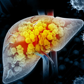 Gan nhiễm mỡ do rối loạn chuyển hóa: Dấu hiệu sớm bạn không nên bỏ qua