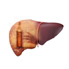 Gan nhiễm mỡ do rượu bia: Nguyên nhân, triệu chứng và phòng ngừa