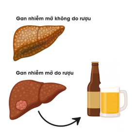 Gan nhiễm mỡ do rượu và không do rượu: Phân biệt ngay