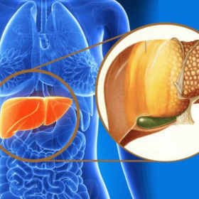 Gan nhiễm mỡ không do rượu: 5 dấu hiệu và cách xử lý