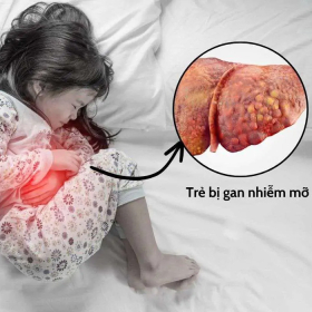 Tất tần tật về gan nhiễm mỡ ở trẻ em mà cha mẹ cần biết