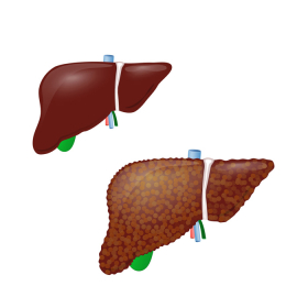 Gan nhiễm mỡ và tiểu đường: Mối liên hệ không thể bỏ qua