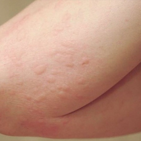 Nóng gan có nguy hiểm không? Cách cải thiện tình trạng nóng gan