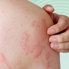 Nóng gan nổi mề đay: Nguyên nhân, triệu chứng và cách xử lí