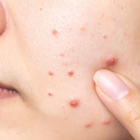 Nóng gan nổi mụn: Dấu hiệu nhận biết và cách cải thiện tình trạng