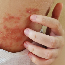 Nóng gan nổi mụn ngứa​ là gì? Dấu hiệu, nguyên nhân và cách phòng ngừa