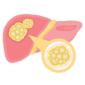 Phân thùy gan là gì? Phân loại, chẩn đoán và phẫu thuật