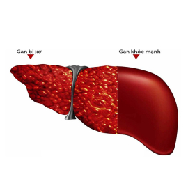 Quá trình phát triển của xơ gan qua từng giai đoạn