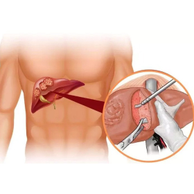 Phẫu thuật cắt gan là gì? Các biến chứng sau phẫu thuật