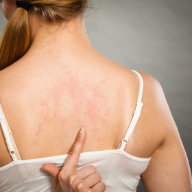  Sẩn ngứa do gan: Dấu hiệu, chẩn đoán, cách xử lý và phòng bệnh