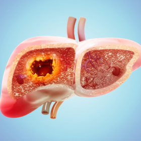 U gan lành tính có nguy hiểm không, sống được bao lâu?