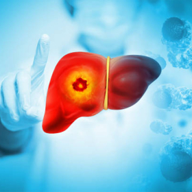 U gan và ung thư gan có khác nhau không? Phân biệt hai bệnh lý này