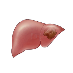 Ung thư biểu mô tế bào gan (HCC): Triệu chứng, chẩn đoán và hướng trị
