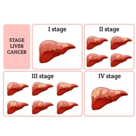 Ung thư gan có mấy giai đoạn? 4 giai đoạn cần biết