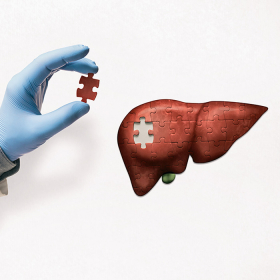 Ung thư gan giai đoạn 2 sống được bao lâu? Tỷ lệ sống là bao nhiêu