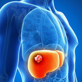 Ung thư gan giai đoạn 3: Độ nguy hiểm, điều trị và phòng ngừa