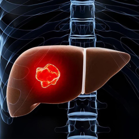 Ung thư gan giai đoạn cuối: Triệu chứng, tiên lượng và biện pháp