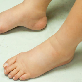 Ung thư gan giai đoạn cuối bị phù chân​: Triệu chứng và phòng ngừa