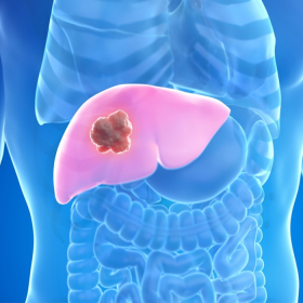 Ung thư gan nôn ra máu là nguyên nhân gì? Lưu ý ngăn ngừa bệnh