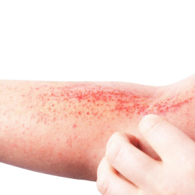 Uống thuốc giải độc gan bị ngứa là do đâu? Cách xử lý như thế nào