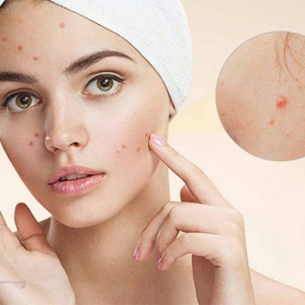 Sự thật về uống thuốc giải độc gan bị nổi mụn mà nhiều người chưa biết