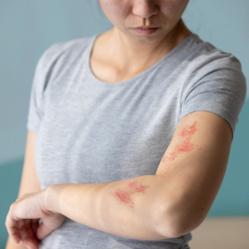 Viêm gan A có những triệu chứng gì?