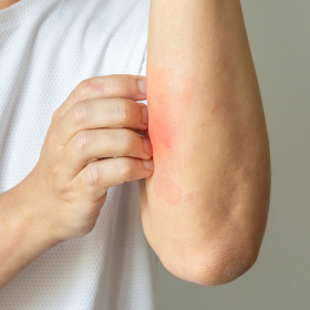 Viêm gan B có bị ngứa không? Cách khắc phục giảm ngứa hiệu quả