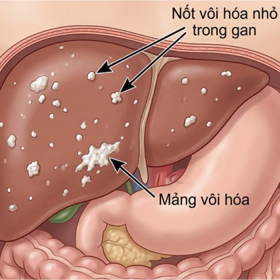 Vôi hóa gan là gì? Nguyên nhân và mức độ nguy hiểm bạn cần biết