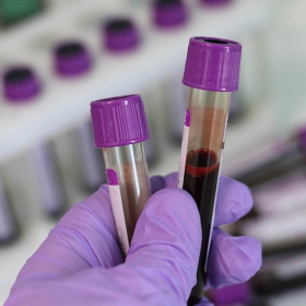 Xét nghiệm ung thư gan: Bí quyết phát hiện sớm hiệu quả