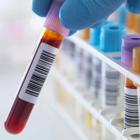 Xét nghiệm xơ gan cần thiết không và có mấy loại xét nghiệm?